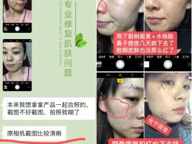 巧巧裂裥菌素4天,痘痘下去了,肤皮也不红了