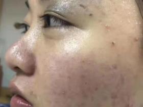 激素脸痒是什么原因,以及皮肤痒之后我们如何去处理?