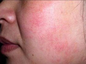 角质层薄、大红脸、红血丝的姐妹最想做的一件事情是什么?怎么做?