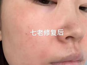 七老修复激素脸一定不会错,好产品和专业的售后