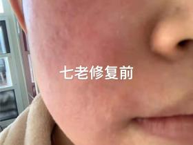 七老修复激素脸一定不会错,好产品和专业的售后