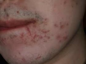 通过七老皮肤从红肿,爆痘,到现在的健康皮肤