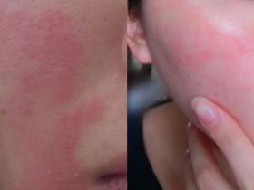 为什么脸部肌肤容易红、痒、刺痛？