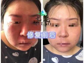 一直在用冻干粉没有得到改善的小姐姐,在洪晴的帮助下皮肤变得平滑有光泽了