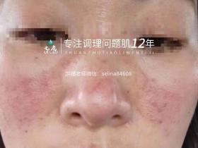 洪晴专注问题肌修复10年 最新玫瑰痤疮成功修复案例七老品牌