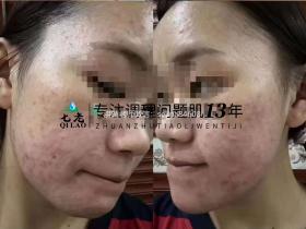 七老激素痘修护案例