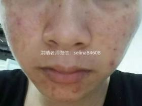 七老敏感肌修护案例