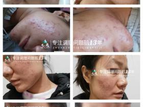 七老激素痘修护案例