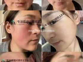 七老红烫肌大红脸修护案例