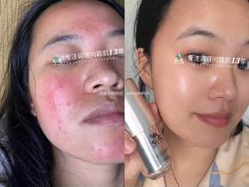 七老激素脸修护案例