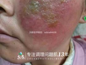 七老激素脸红肿痒渗液流黄水修护案例