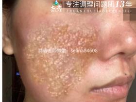 七老严重激素脸修护案例