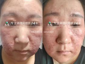 七老激素脸修复案例