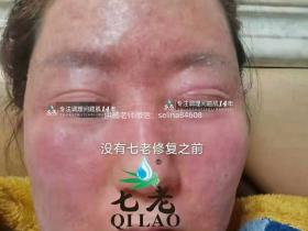 七老严重激素脸修复案例