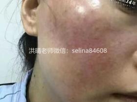 七老红烫疹子修护案例