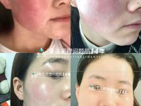 七老激素脸玫瑰修复案例