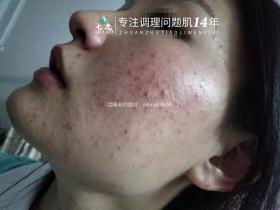 七老激素脸顽固痘痘修复案例