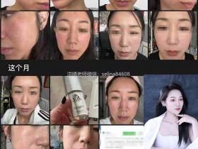 七老激素脸修复案例