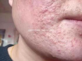 七老激素脸激素痘修护案例