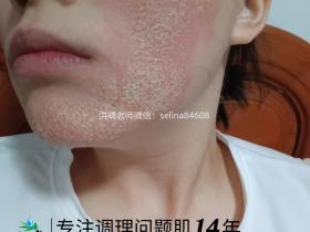 七老激素脸修护案例