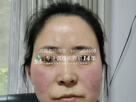 七老红烫肌修护案例