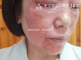 七老玫瑰皮修护案例