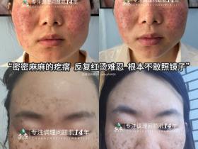 七老剥脱祛斑屏障受损激素脸修护案例