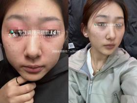 七老眼周反复过敏修护案例