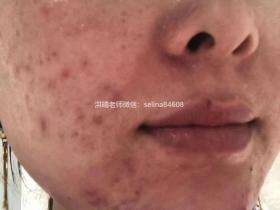 七老激素脸修复案例