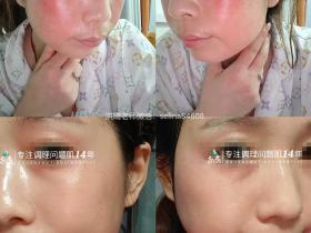 七老屏障受损角质层薄红热修复案例