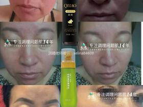 七老激素脸发红发烫角质层薄修护案例