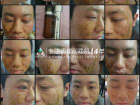 七老严重激素脸修护记录