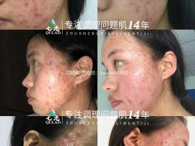 七老激素痘脓包痘修护案例