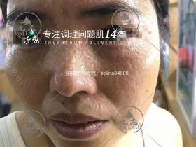 七老日光性皮炎修护案例