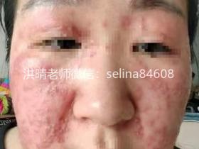 七老严重激素脸修复案例