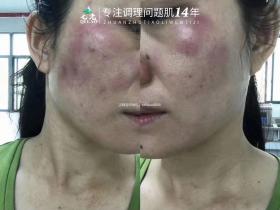 七老反复过敏修复案例