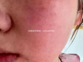 七老玫瑰脸修护案例
