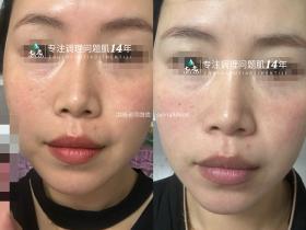 七老传明酸精华修护十天对比反馈