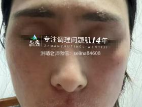 七老激素脸修护案例
