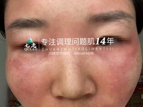 七老激素脸修护案例