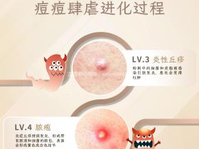 痘痘的进化过程,痘痘怎么区分?