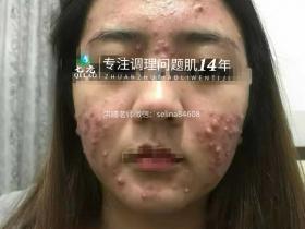 七老激素脸顽固性脓包痘痘修护案例