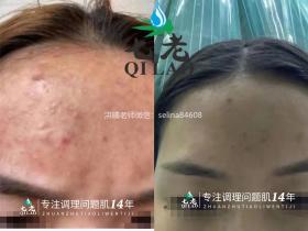 激素脸激素痘顽固性粉刺痘痘修护案例