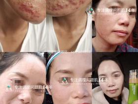七老严重激素脸脓包痘痤疮修护案例
