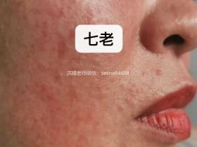 七老激素脸修护案例