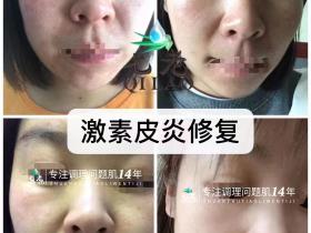 七老激素脸修复案例