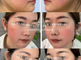 七老激素脸红烫大红脸修护案例
