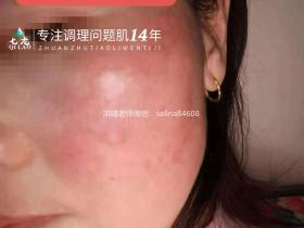 七老红烫肌发红发烫大红脸修护记录