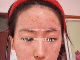 七老激素脸玫瑰脸修护案例