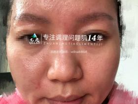 七老激素脸修护案例